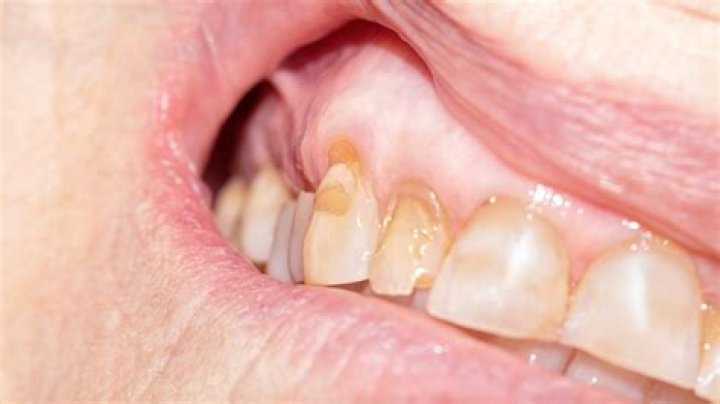 Can teeth be whitened if enamel is gone?