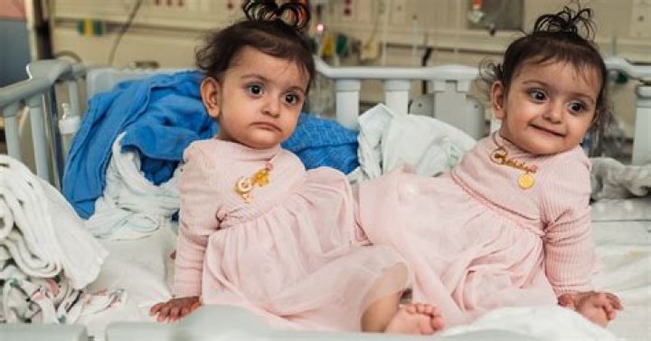 Can there be boy and girl conjoined twins?