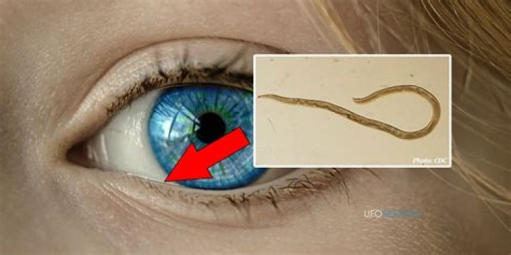 Can threadworms go in your eyes?