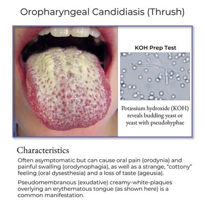 Can thrush symptoms be something else?