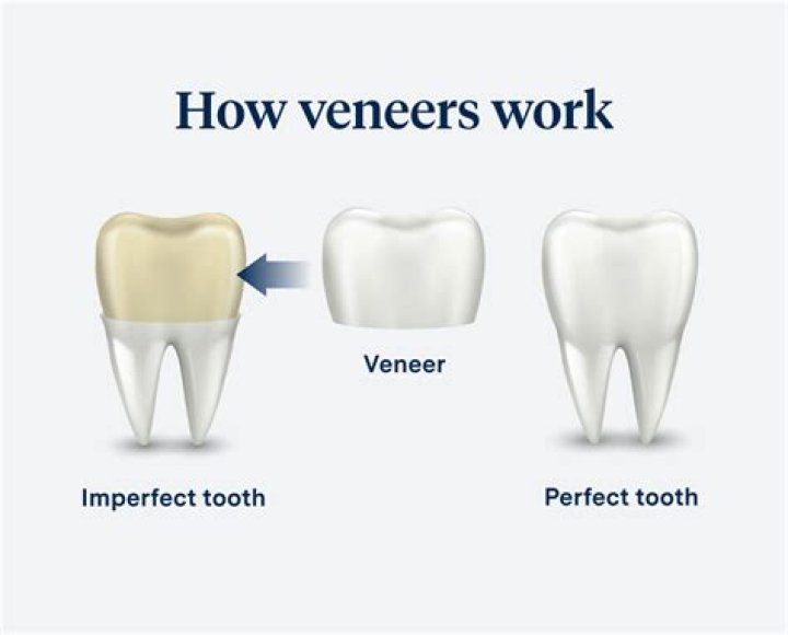 Can veneers be glued back on?