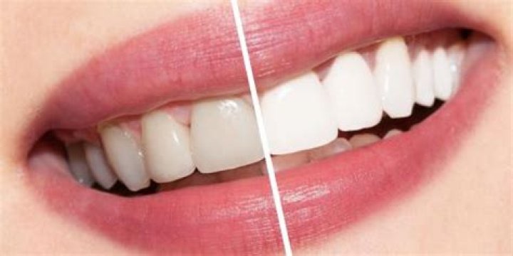 Can veneers be whitened?