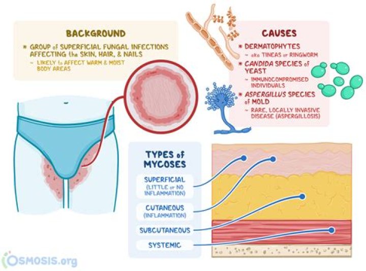 Can water flush out yeast infection?
