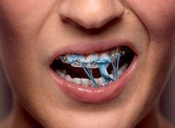 Can you chew gum with braces?