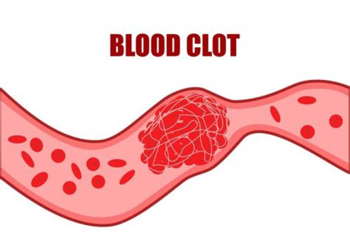 Can you dissolve a blood clot?