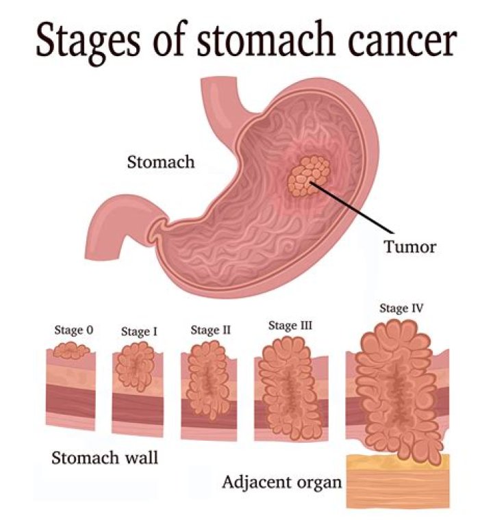 Can you feel a stomach tumor?