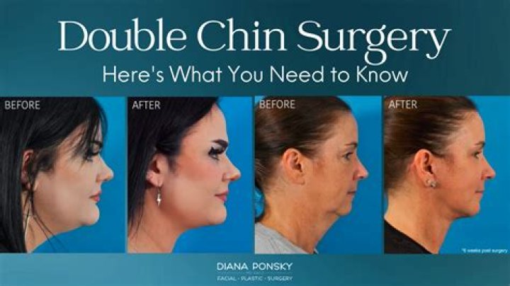Can you fix a double chin?