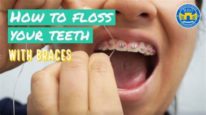 Can you floss your back teeth with braces?