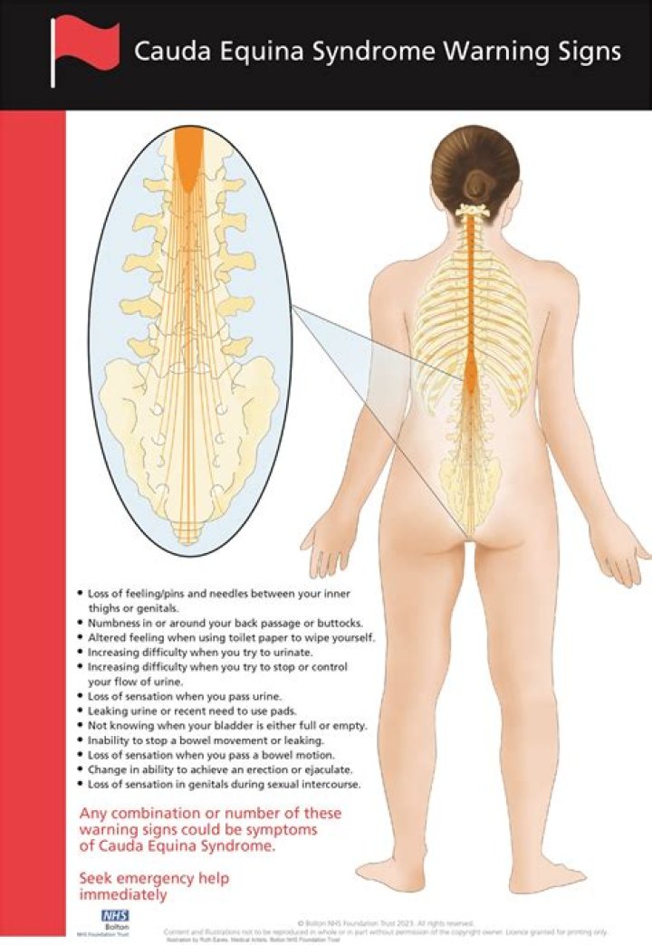 Can you fully recover from cauda equina syndrome?