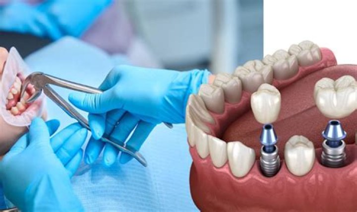 Can you get a temporary tooth while waiting for an implant?