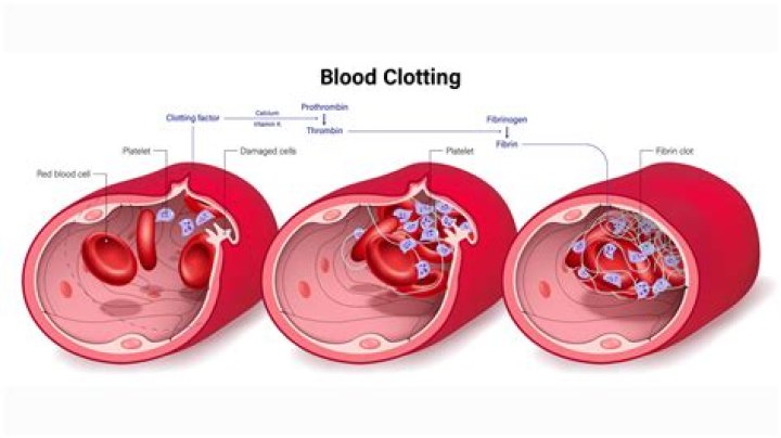 Can you get blood clots while sleeping?