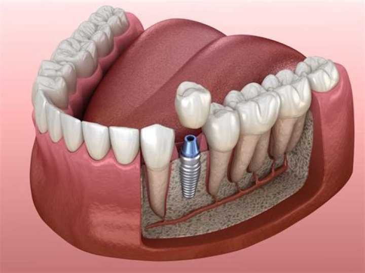 Can you get implants for back teeth?
