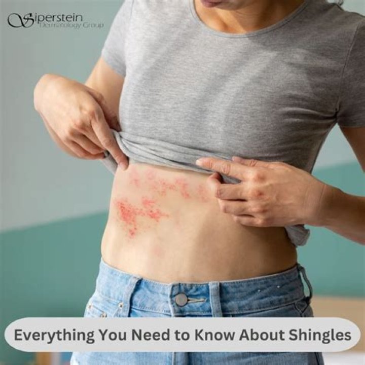 Can you have shingles without the rash or blisters?