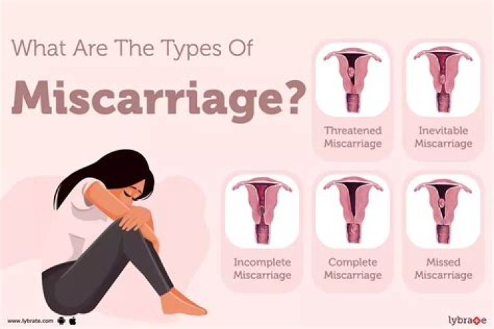 Can you miscarry and still be pregnant with a twin?