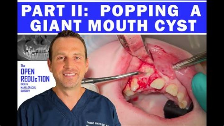Can you pop a cyst in your mouth?