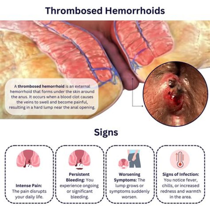 Can you put ice directly on hemorrhoid?