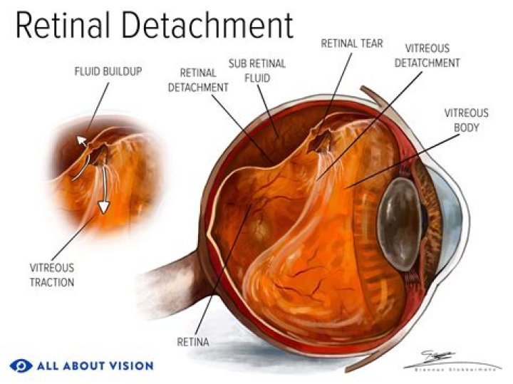Can you read with a detached retina?