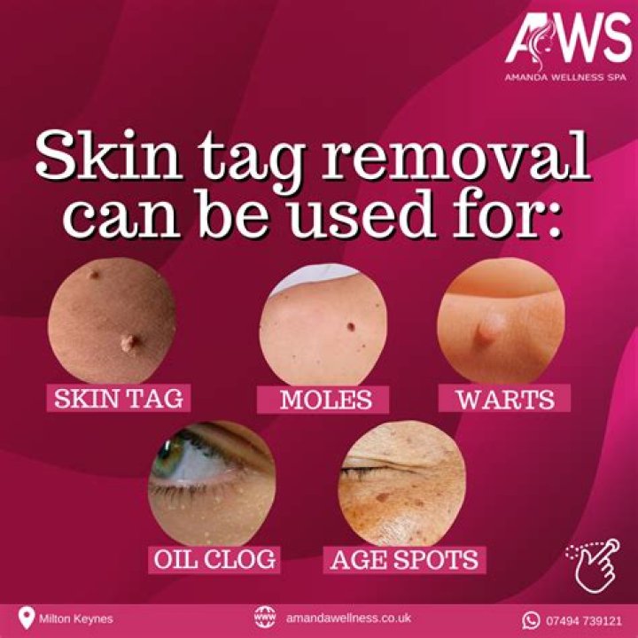 Can you remove large skin tags yourself?