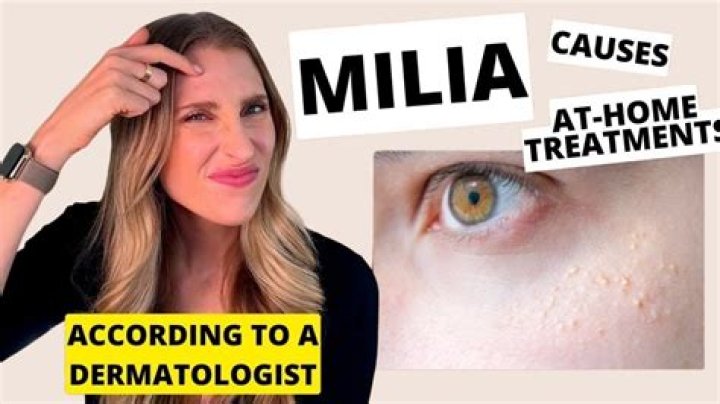 Can you remove milia at home?