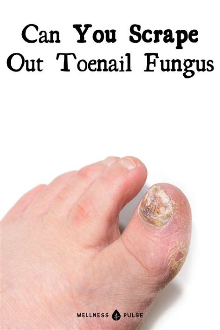 Can you scrape out toenail fungus?