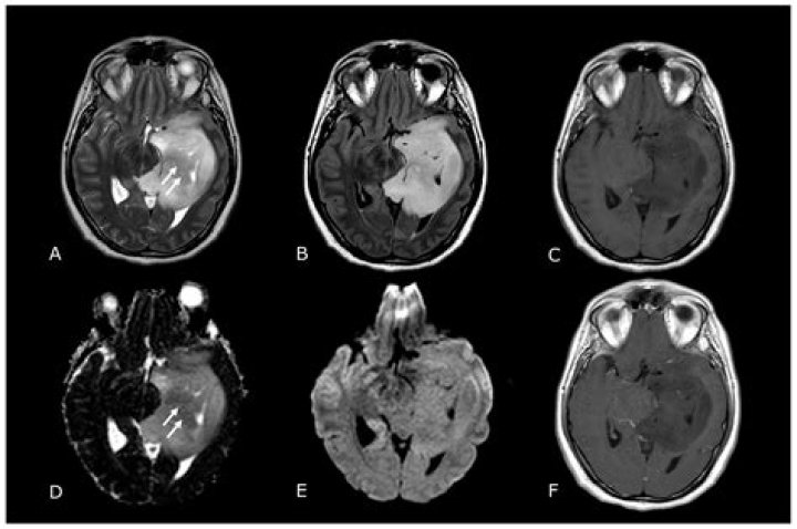 Can you see brain tumor on MRI without contrast?