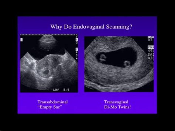 Can you see twins at 5 weeks?