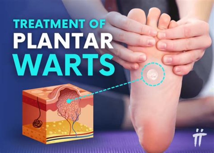 Can you suffocate a plantar wart?