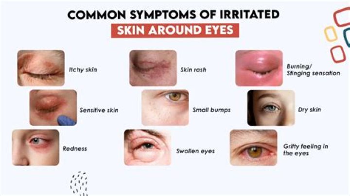 Can your own urine irritate your skin?