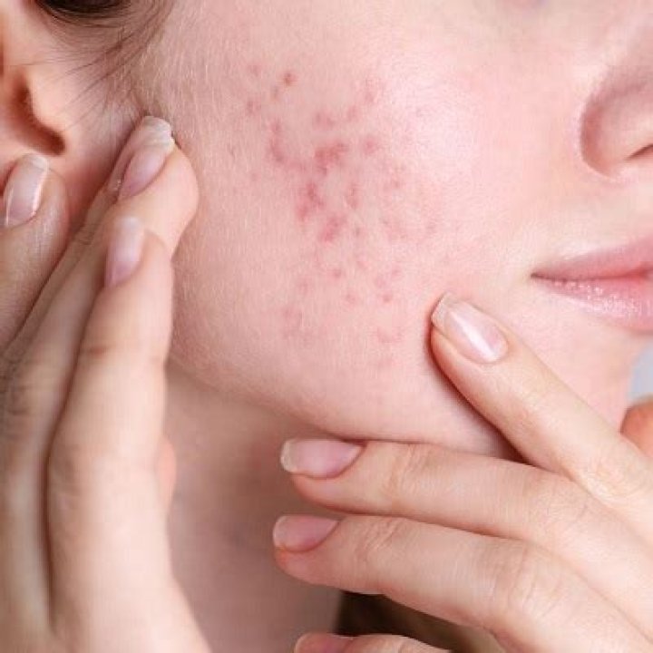 Do acne scars get worse with age?