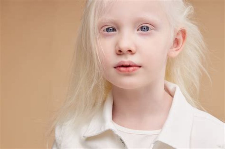Do albinos have a shorter life span?