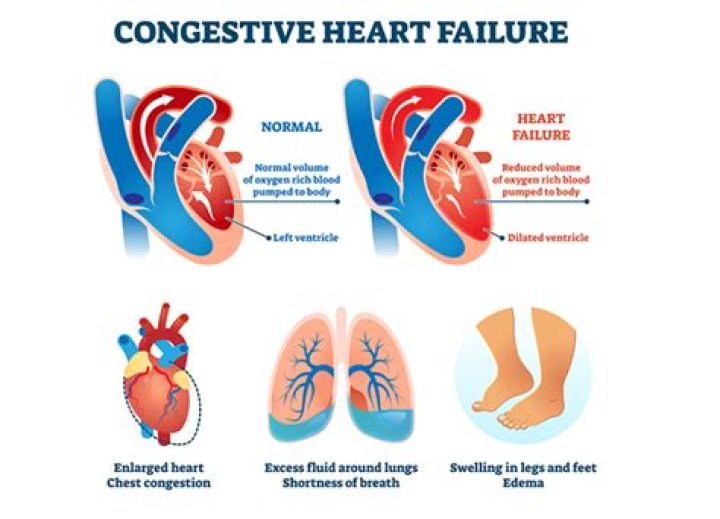 Do blood thinners help congestive heart failure?