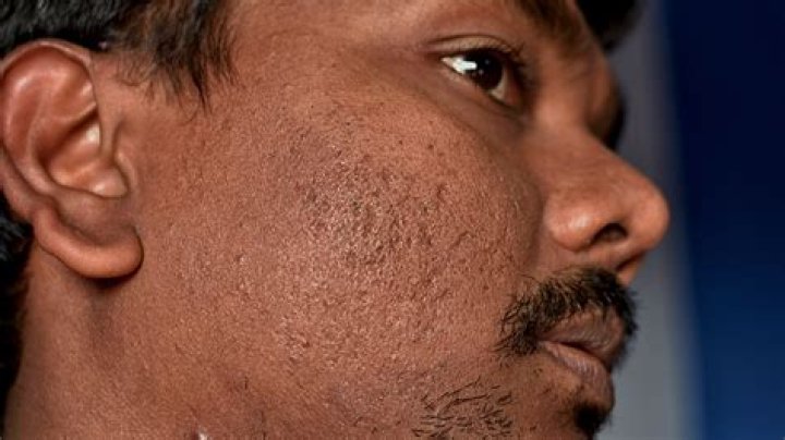 Do dark scars go away?