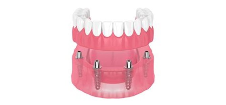 Do dentures hurt at first?