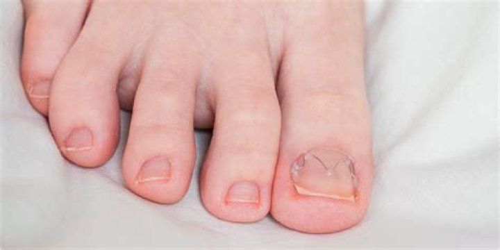 Do Epsom salts help neuropathy?