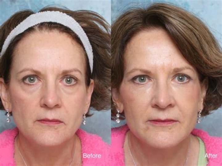 Do eye bags make you look older?