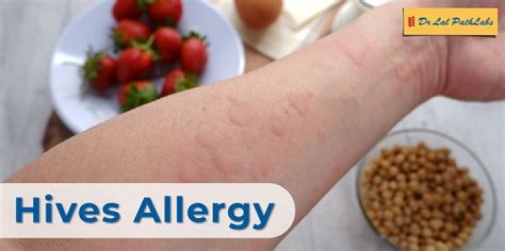 Do hives get crusty?