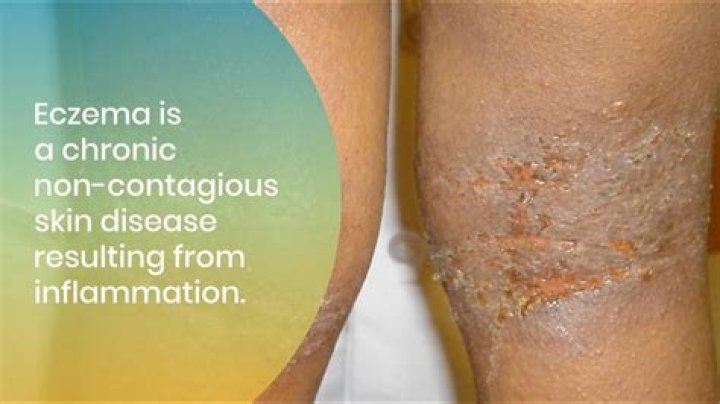 Do people with eczema have low zinc?