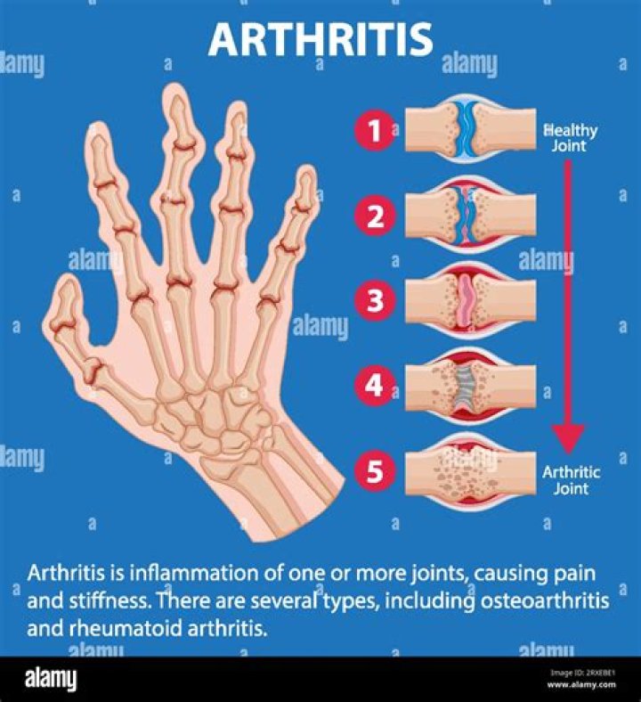 Do pianists get arthritis?