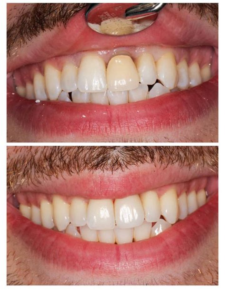 Do porcelain crowns get yellow?