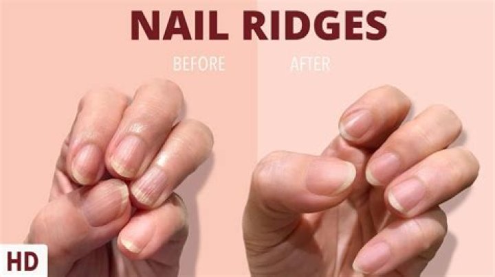 Do ridges in your fingernails mean anything?