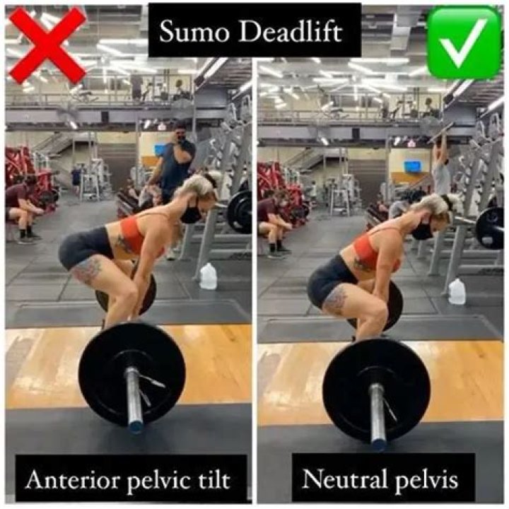 Do squats help anterior pelvic tilt?