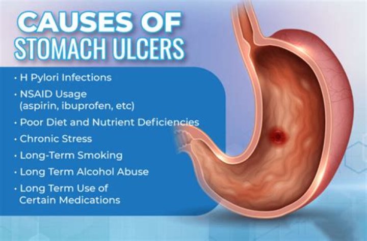Do stomach ulcers cause back pain?