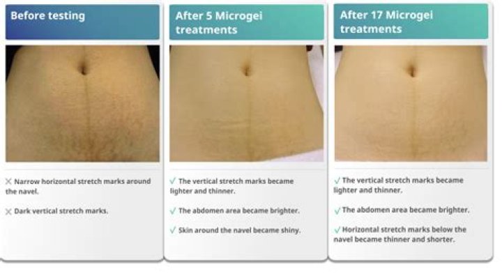 Do stretch marks go away?