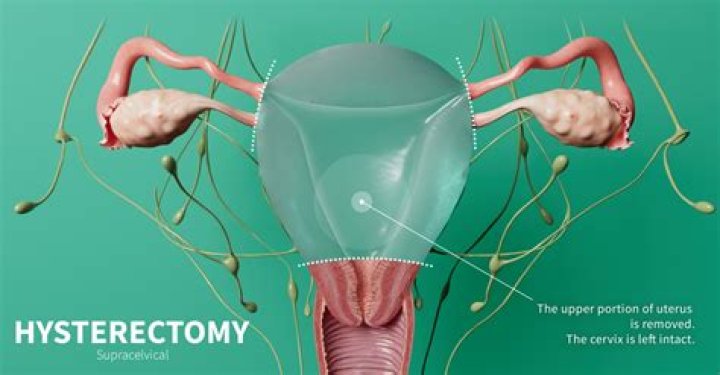 Do you leak after a hysterectomy?