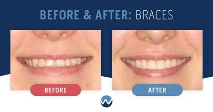 Do you look better after braces?