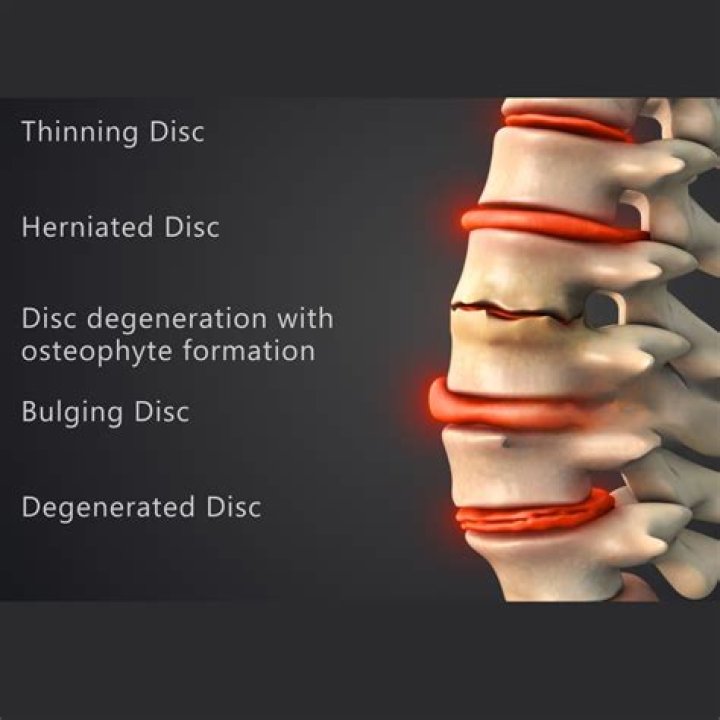 Does a herniated disc get worse before it gets better?