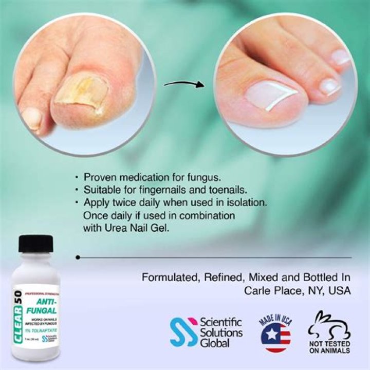 Does antifungal cream work on scabies?