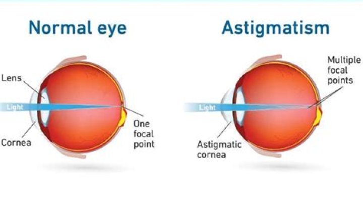 Does astigmatism increase with age?