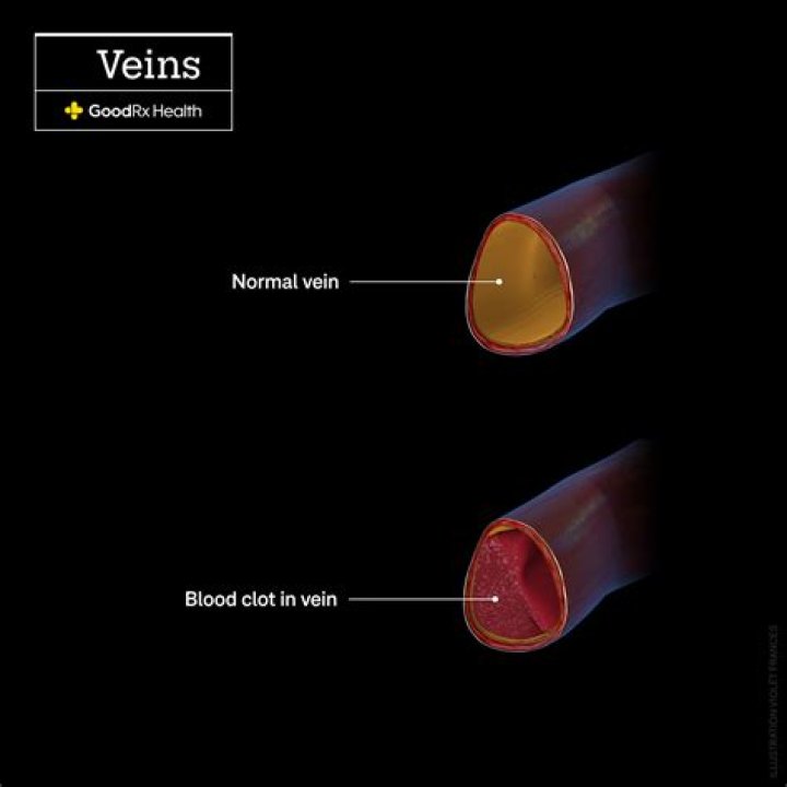 Does blood clot pain come and go or is it constant?