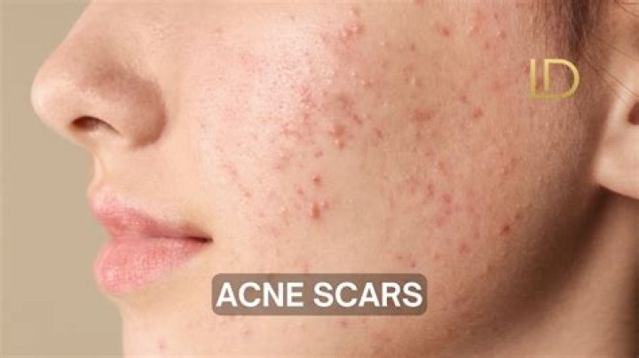 Does boba cause acne?